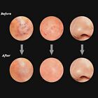 3x Blackhead Remover Tool Black Spots Needles Pore Cleanser Extractor Tool AUS