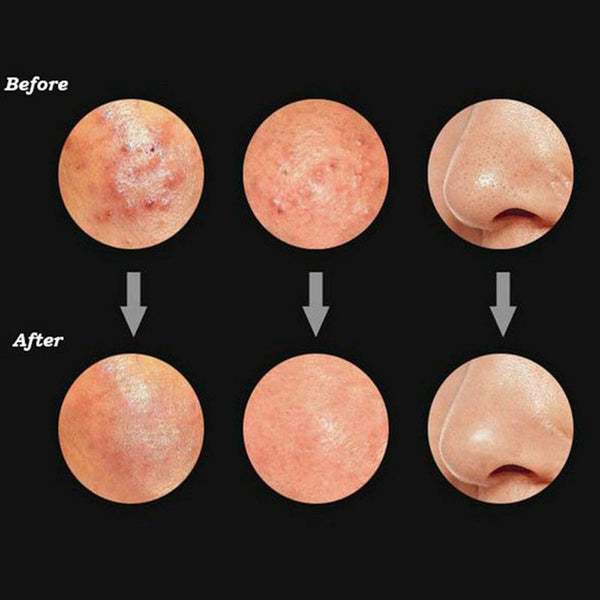 3x Blackhead Remover Tool Black Spots Needles Pore Cleanser Extractor Tool AUS