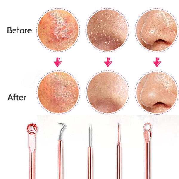 4pc Blackhead Remover Propper Tool Pimple Pore Blemish Comedone Acne Cleaner Kit